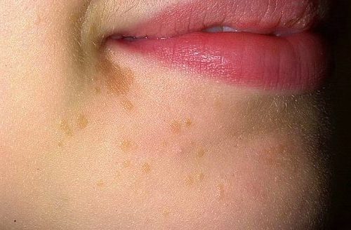 Flat Warts Symptoms Causes And Ways Of Treatment Med Warts