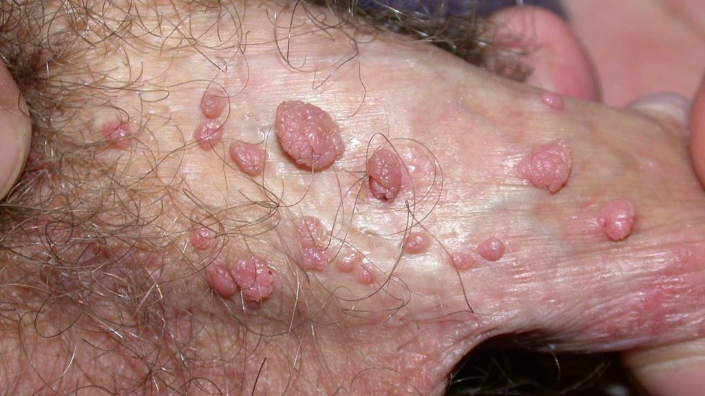 Genital Wart Treatment All Important Nuances You Should Know Med Warts 