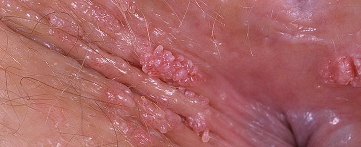 What Are the Causes of Genital Warts in Men? 