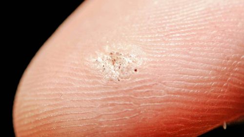 What Is Plantar Wart and How to Differentiate It from Other Wart Types ...